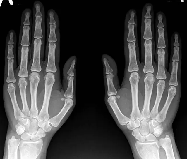 Arthrite du poignet à la radiographie avant d'utiliser Hondroine