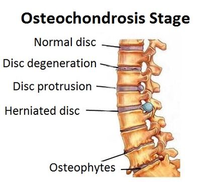 Stades d'ostéochondrose