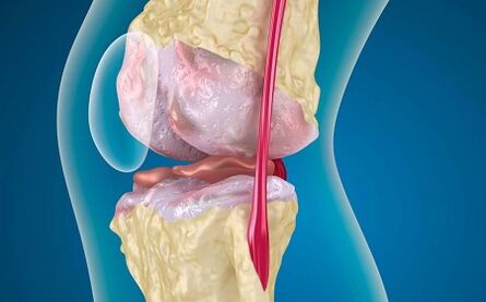 Les raisons du développement de l'arthrose de l'articulation du genou